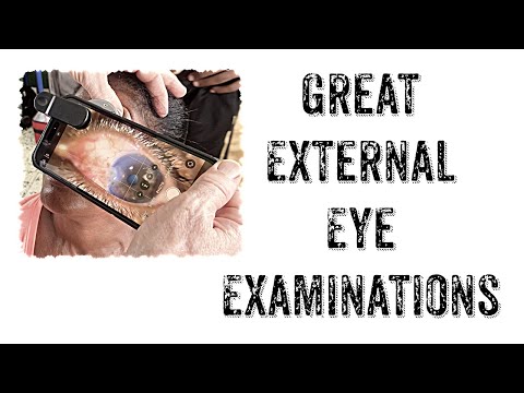 Great External Eye Examinations in a Low Resource Environment