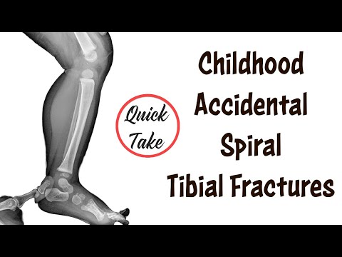 Toddler's Fractures and C.A.S.T. Fractures Quick Take