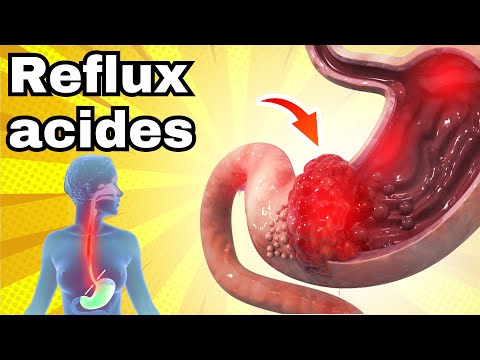 Ne mange pas ces aliments avec le REFLUX ACIDE