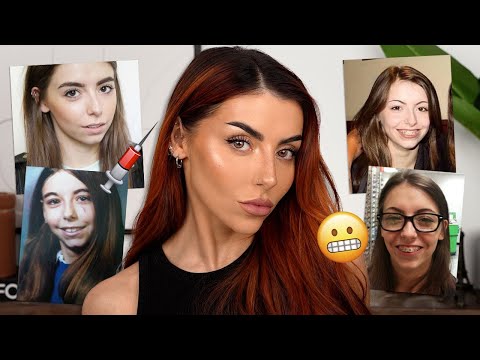 EVERYTHING I’ve had done to my face | The TRUTH - Botox, Fillers, Surgery..