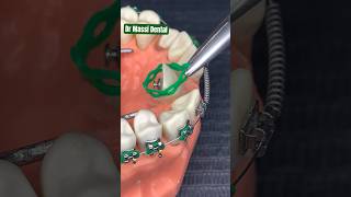 Dental Braces, Straight Orthodontist