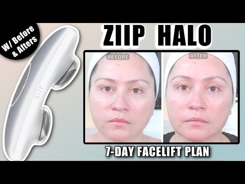 ZIIP HALO 7-DAY FACELIFT | With Before & Afters