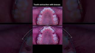 Don't worry about tooth extraction with braces #ardaarisan