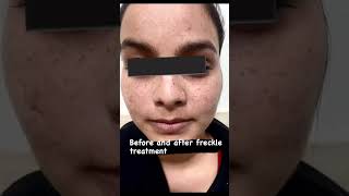 freckle treatment, Laser treatment #beautyhacks #beauty #trending