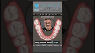 What are invisalign aligners overcorrection trays? #invisalign #dentist