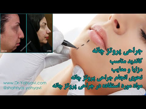 توضیحات جامع دکتر شهریار یحیوی پیرامون جراحی پروتز چانه