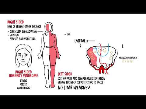 Medulla Oblongata Syndromes - Medial and Lateral Medullary Syndrome, Medullary Lesions