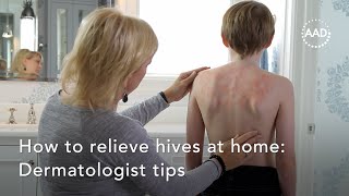 How to relieve hives at home