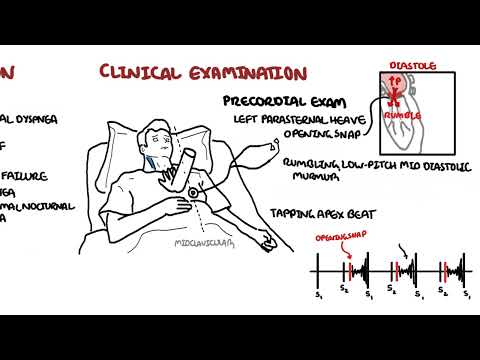 Mitral Stenosis - causes, pathophysiology and treatment