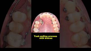 Pulling out hidden teeth when braces #braces #orthodontist #dentist #bracesoff