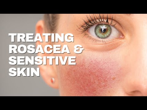 Treating Sensitive Skin & Rosacea