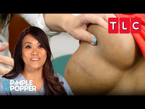 Longest-Lasting Squeezes | Dr. Pimple Popper | TLC