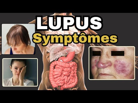 SYMPTÔMES les plus fréquents du LUPUS