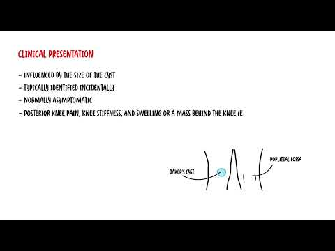 Baker's Cyst Knee - posterior knee swelling and pain