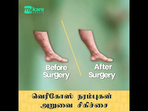 Vericose Veins Treatments | Vericose Veins Surgery | Mykare Health (Tamil)