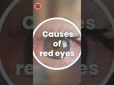 Causes of red eye