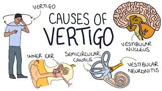 Understanding the Causes of Vertigo