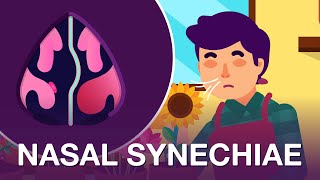 Another Nasal Blockage? It Might Be Nasal Synechiae