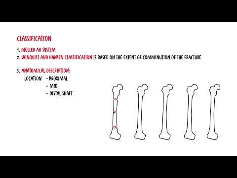 Femoral Shaft Fracture - mechanism and types