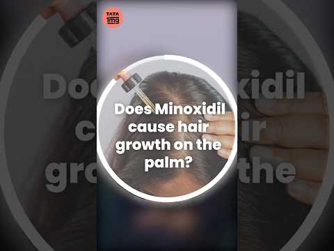 Can Minoxidil application cause hair growth on palms?