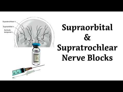 Anesthetic Blocking of the Supraorbital and Supratrochlear Nerves