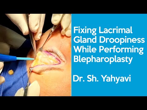 Fixing Lacrimal Gland Droopiness While Performing Blepharoplasty