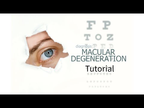 A Wet Macular Degeneration Treatment Tutorial