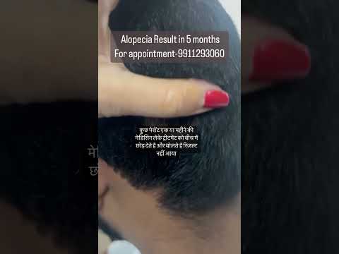 Alopecia result in 5 months Treatment by Dr Rekha Saroha