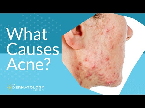 What Causes Acne? | Explained by Dermatologist