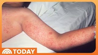 Measles outbreak spreads to 15 states with cases on the rise