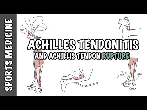 Achilles Tendonitis and Tendon Rupture - Overview