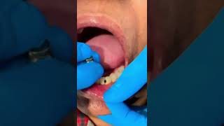 LIVE🔴: Artificial Teeth Replacement | Dental Care | Eledent Dental Hospitals | #shorts #dentalcare