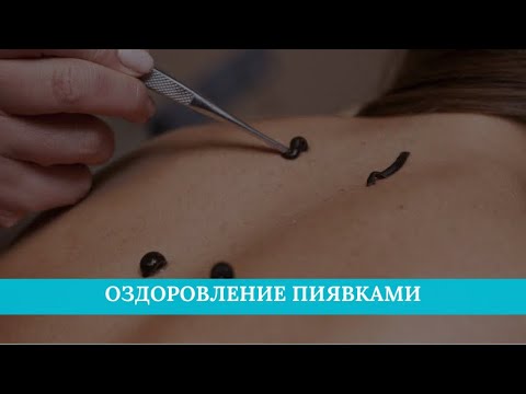 Оздоровление пиявками