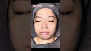 Bojin Facial Walkthrough at Kosme Aesthetics