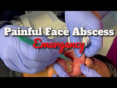 We Drain a Painful Facial Abscess in a Teenager