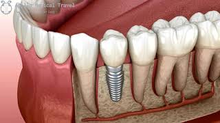 Animated Dental Implant Procedure | Apollo Medical Travel