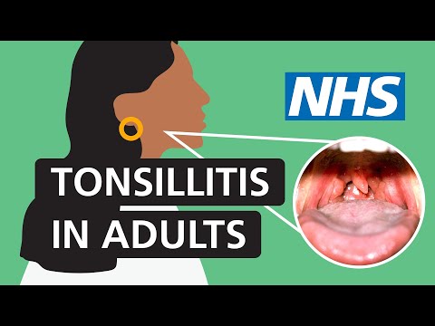 Tonsillitis in adults: Symptoms and treatment | NHS