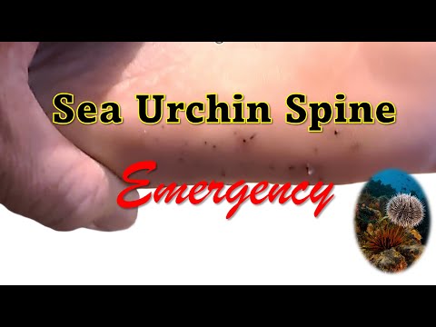 Sea Urchin Spine Emergency in the Dominican Republic