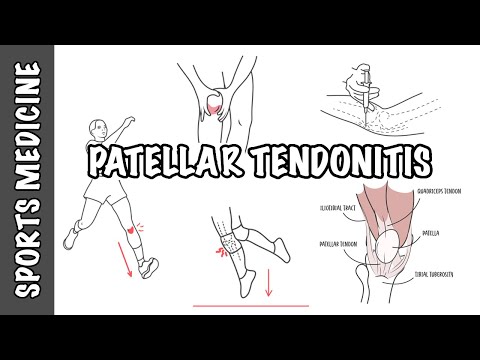 Patellar Tendonitis and Patellar Tendinopathy