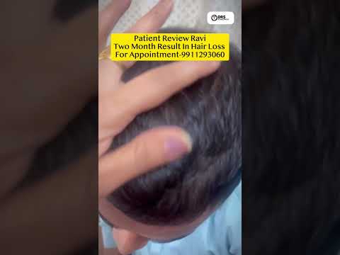 Two month result in Hair loss #shortvideo #hairlosstreatment